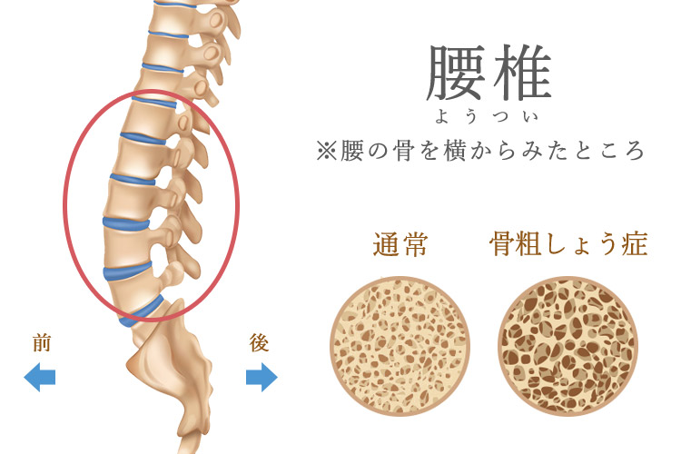 骨粗しょう症のイメージ画像