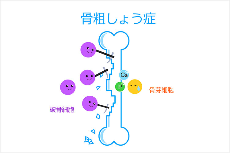 骨のリモデリングの図